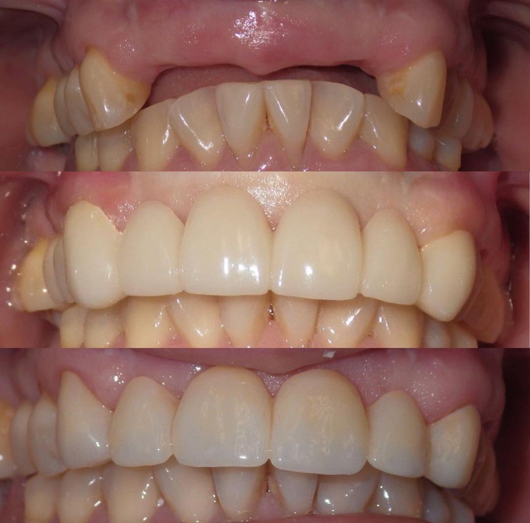 Before and after dental restoration showing improved tooth alignment and color at Sonoran Dental Studio