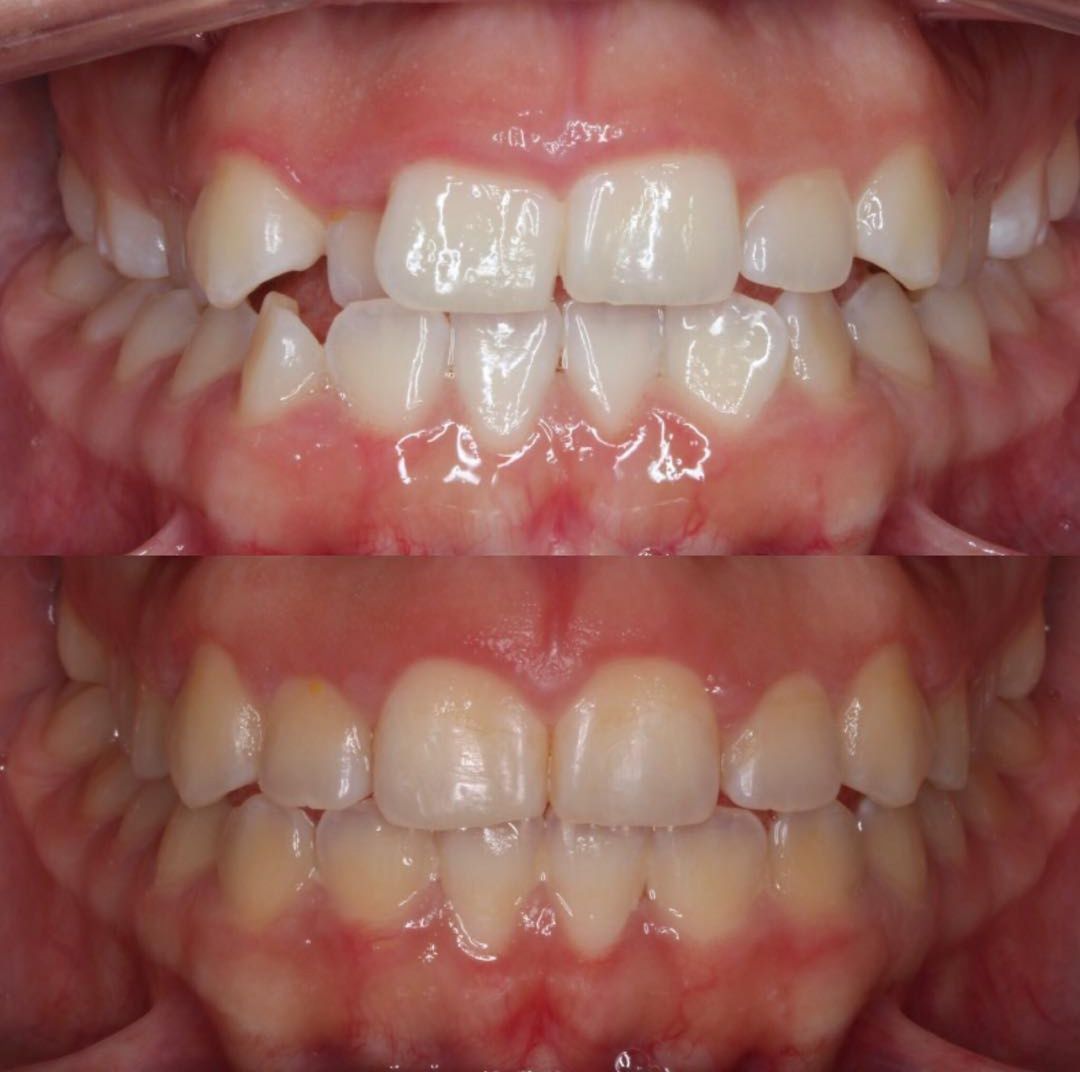 Intraoral before and after comparison of dental implant or restoration treatment